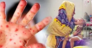 ২৪ ঘণ্টায় হাম ও উপসর্গে আরও ১০ শিশুর মৃত্যু